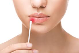 El herpes labial (conocido popularmente como calentura o fuego) es una infección vírica muy frecuente que causa pequeñas ampollas llenas de líquido en los labios o alrededor de la boca.